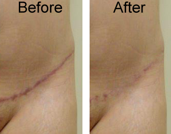 Before-After-Scar - Dr. Michael Gray (Michigan)