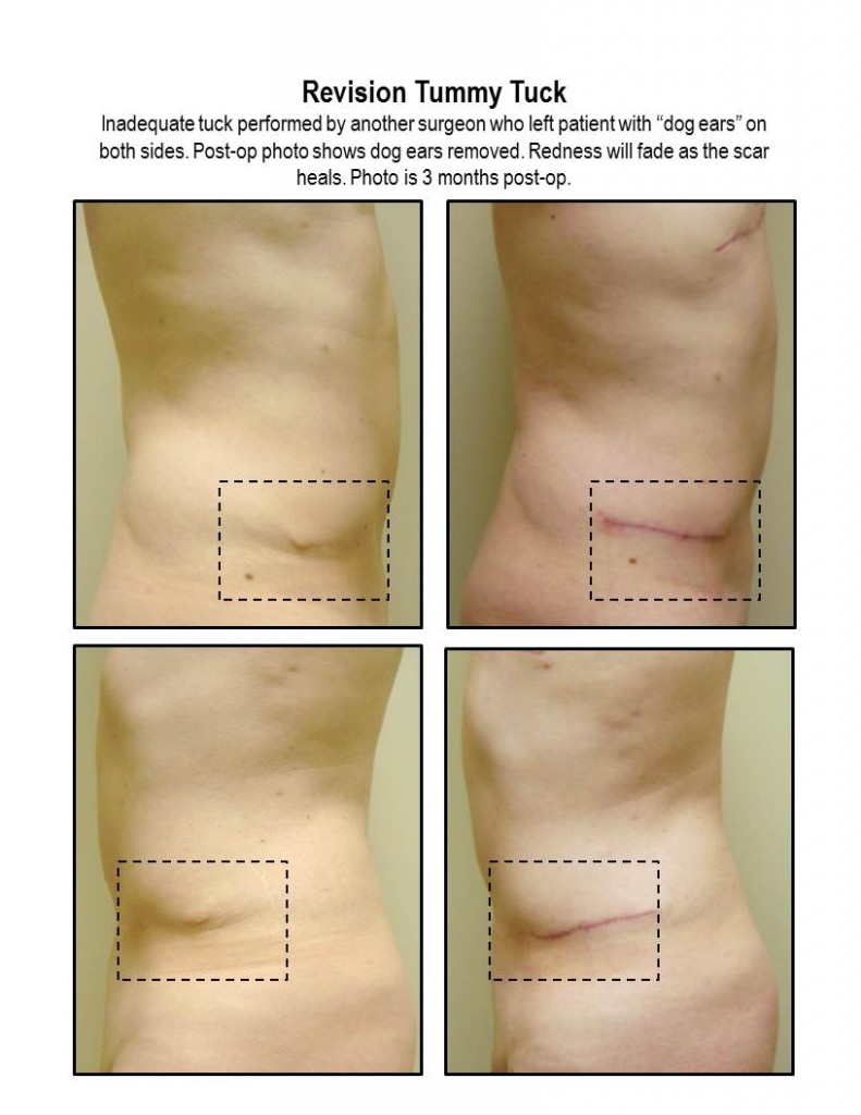 Tummy Tuck Correction By Dr. Michael Gray (Botched)