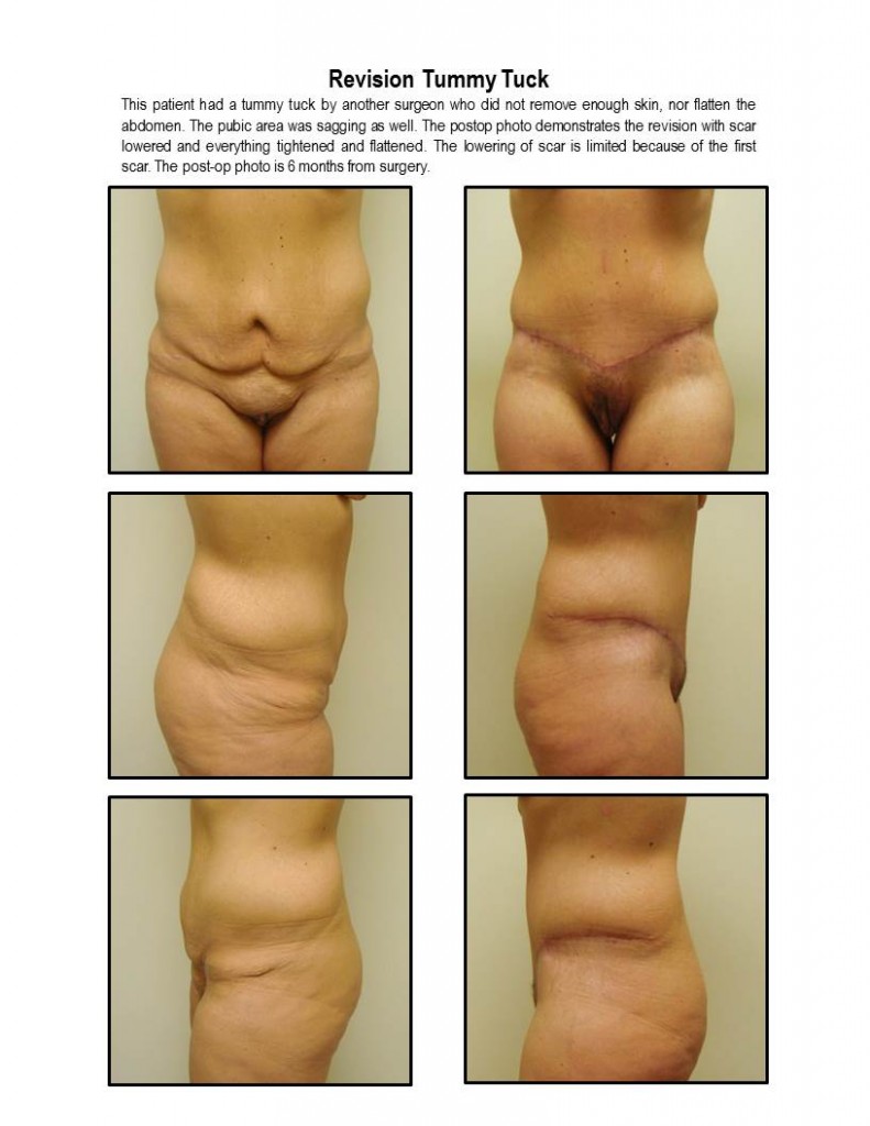 Tummy Tuck Correction By Dr. Michael Gray (Botched)