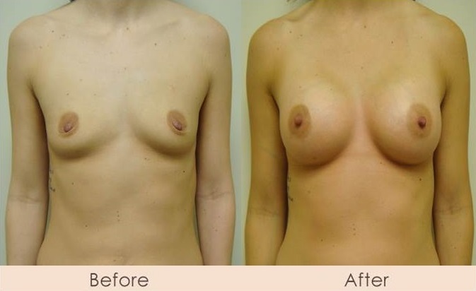 Scarless Breast Enlargement, 200cc - 240cc Under Muscle
