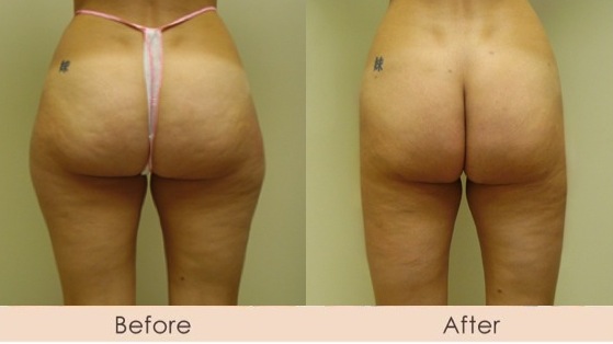 Liposuction of Outer Thighs