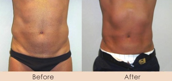 Male Liposuction of Abdomen and Waist