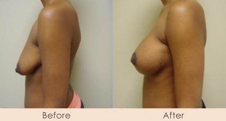 Breast Lift with Scarless Breast Implants, Left 325 - 325cc  Right 325 - 400cc