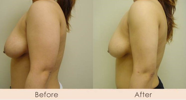 Liposuction of Arms