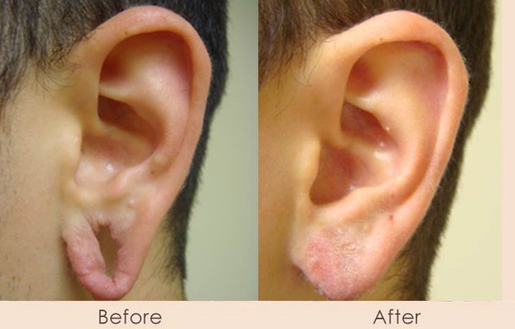 Ear Reconstruction - Otoplasty