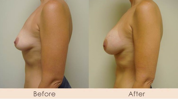 Scarless Breast Enlargement