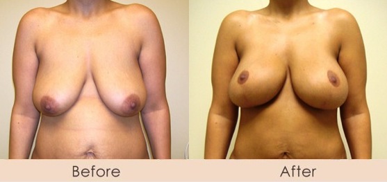 Breast Augmentation (Endobam)  300-340cc saline implants under muscle<br />External Ultrasonic Liposuction of Abdomen & Waist<br />Mini Tuck Abdomen