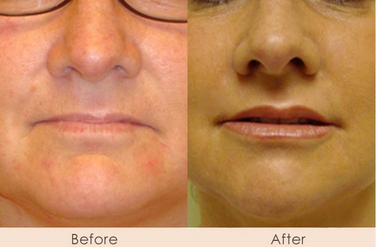 Alloderm to Marionette and Nasal Folds