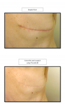 therascr photo back scar