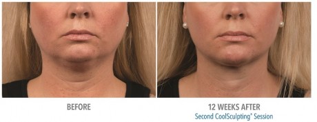 Double Chin Coolsculpting 01