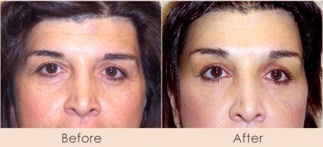 Eyes-Cosmetic Surgery-Dr Gray