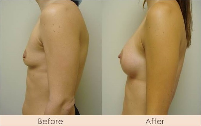 Scarless Breast Enlargement, 200cc - 240cc Under Muscle
