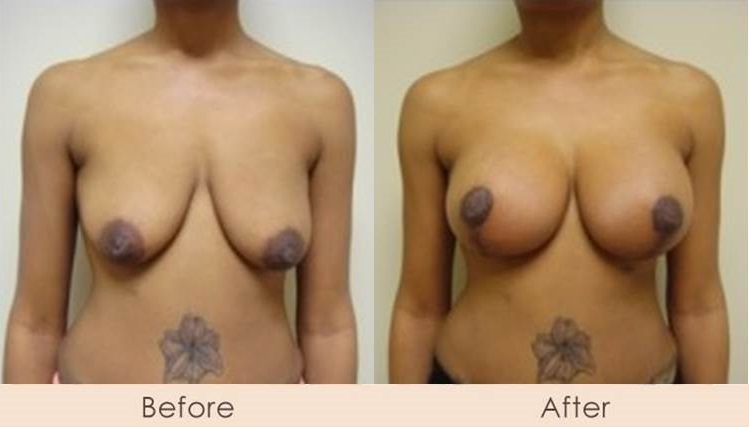 Breast Lift with Scarless Breast Implants, Left 325 - 325cc  Right 325 - 400cc