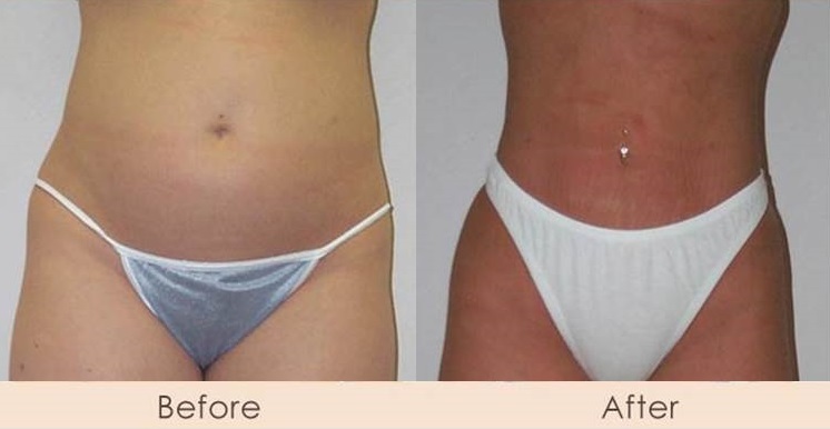Liposuction of Abdomen