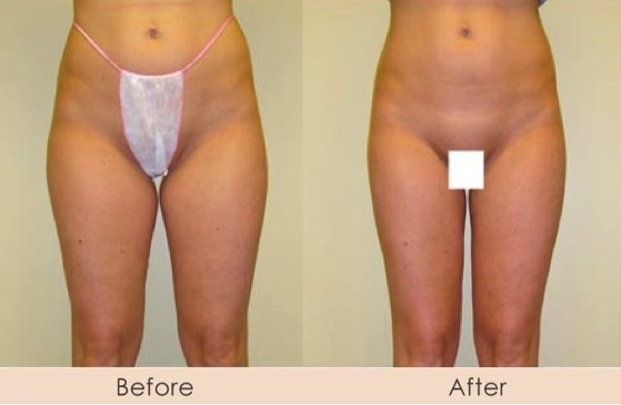 Liposuction of Outer Thighs