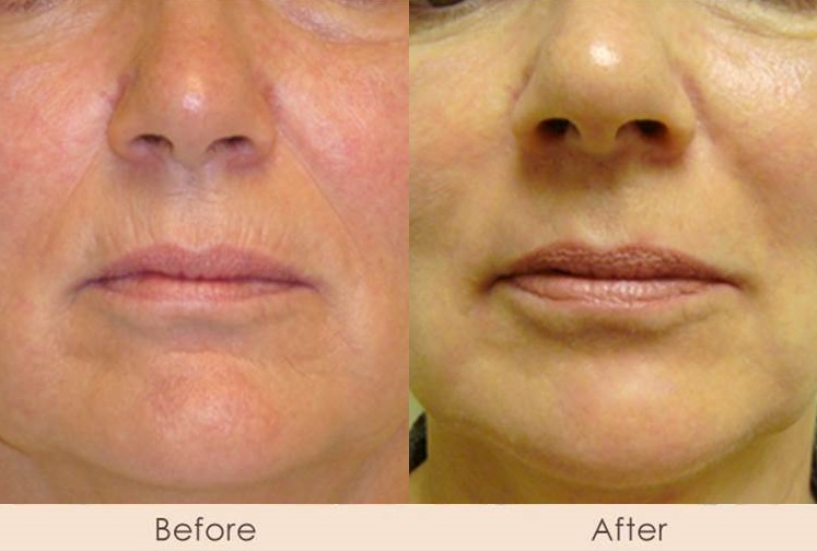 Alloderm to Marionette and Nasal Folds