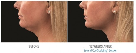 Double Chin Coolsculpting 02